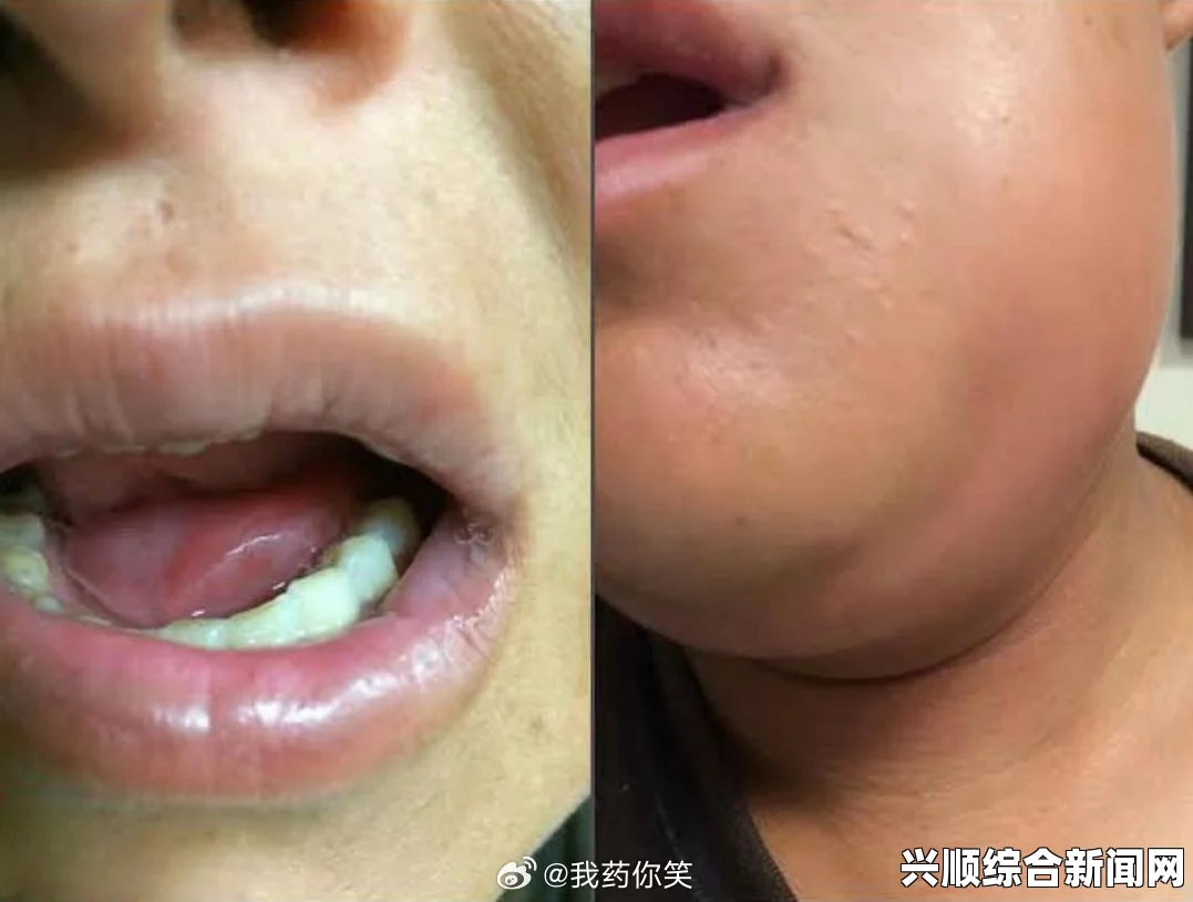 小嘴无力合拢红肿外翻怎么办：多种原因导致的口腔与面部健康问题解析，及其有效治疗方法与预防措施