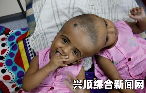 印度连体兄弟的非凡生活，独立上半身与独特自理能力揭秘（图文报道）