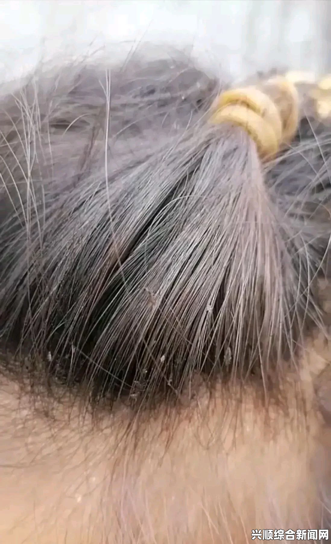 英女孩遭遇罕见严重头虱危机