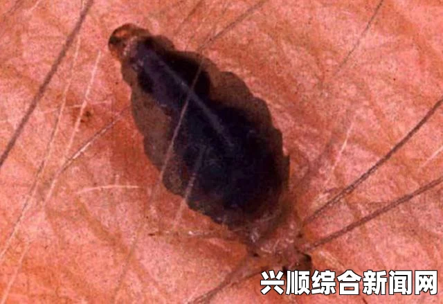 英女孩虱患危机，触目惊心的现实挑战