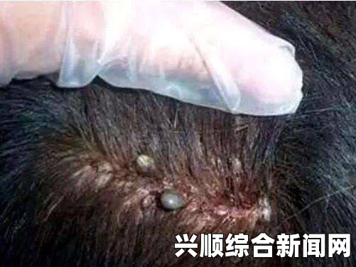 英一女孩头发长满虱子，触目惊心的现实挑战