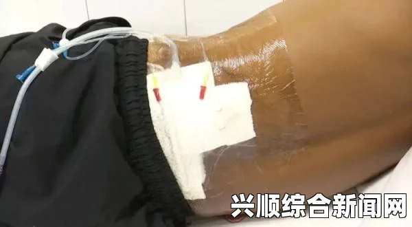 美国男子iPhone 6手机折弯自燃引发臀部烧伤事件